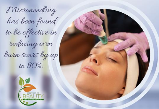 A woman laying down receiving a PRP Vampire Facials/Microneedling