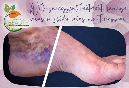 A foot displayed before and after Sclerotherapy Treatment