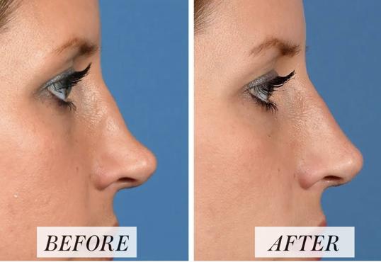 before and after treatment for Non surgical rhinoplasty