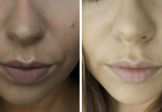 Nasolabial fold filler